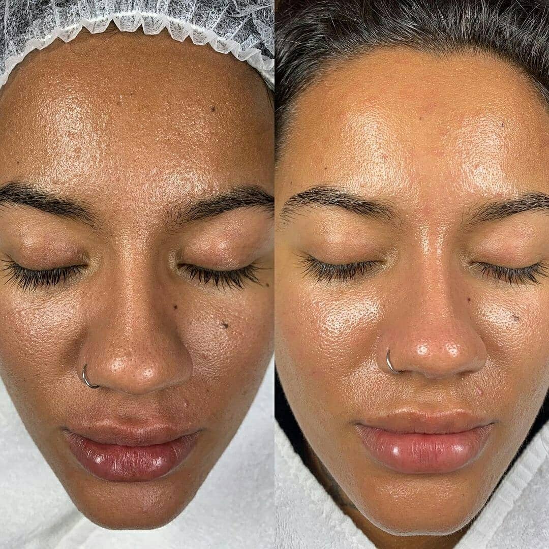 Dermabrasion-before-and-after-hydrabrasion-toronto-ontario