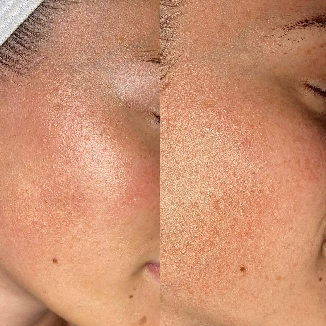dermabrasion-before-and-after-e1713881709345
